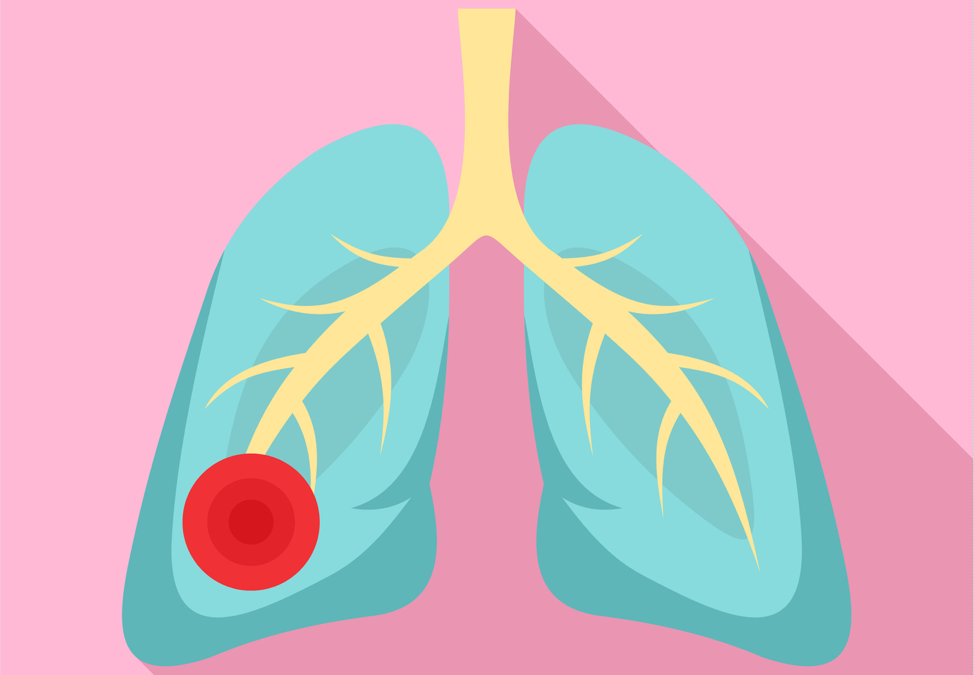 How Does Asbestos Exposure Affect the Lungs?