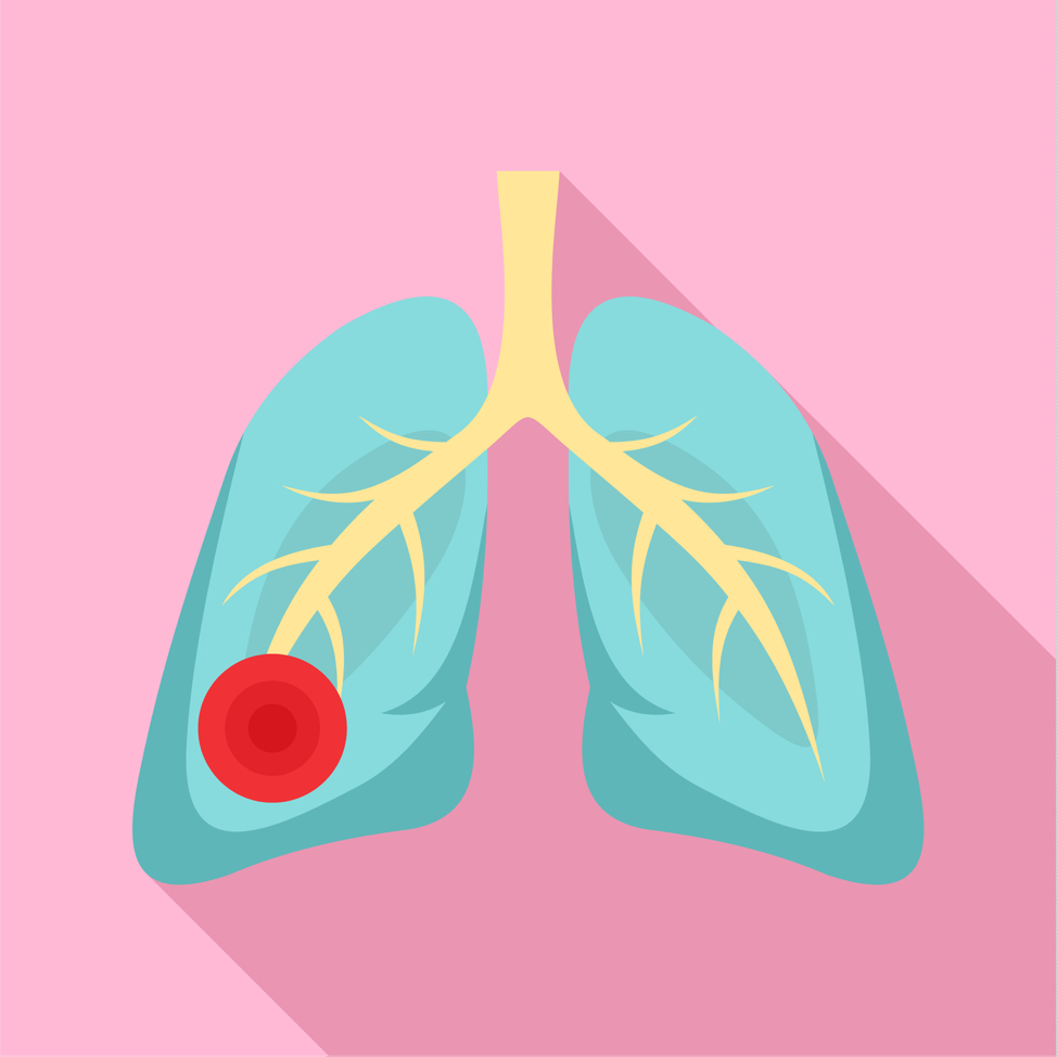 How Does Asbestos Exposure Affect the Lungs? Axis Response Group